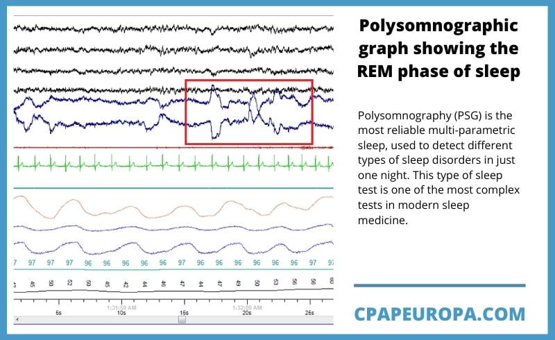 Polysomnographic graph showing REM sleep