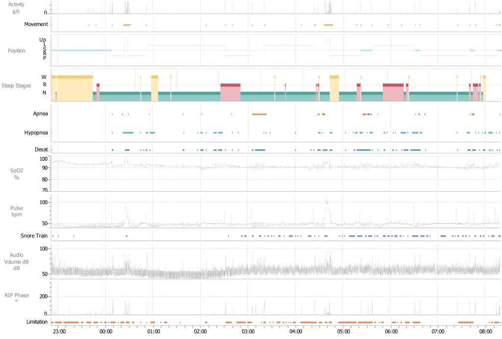 Nox T3s BodySleep Report Т3s Polysomnography Device