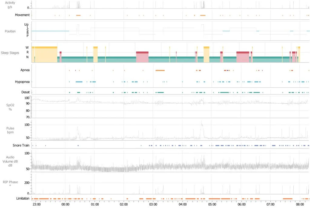 Nox T3s BodySleep Report Т3s Polysomnography Device